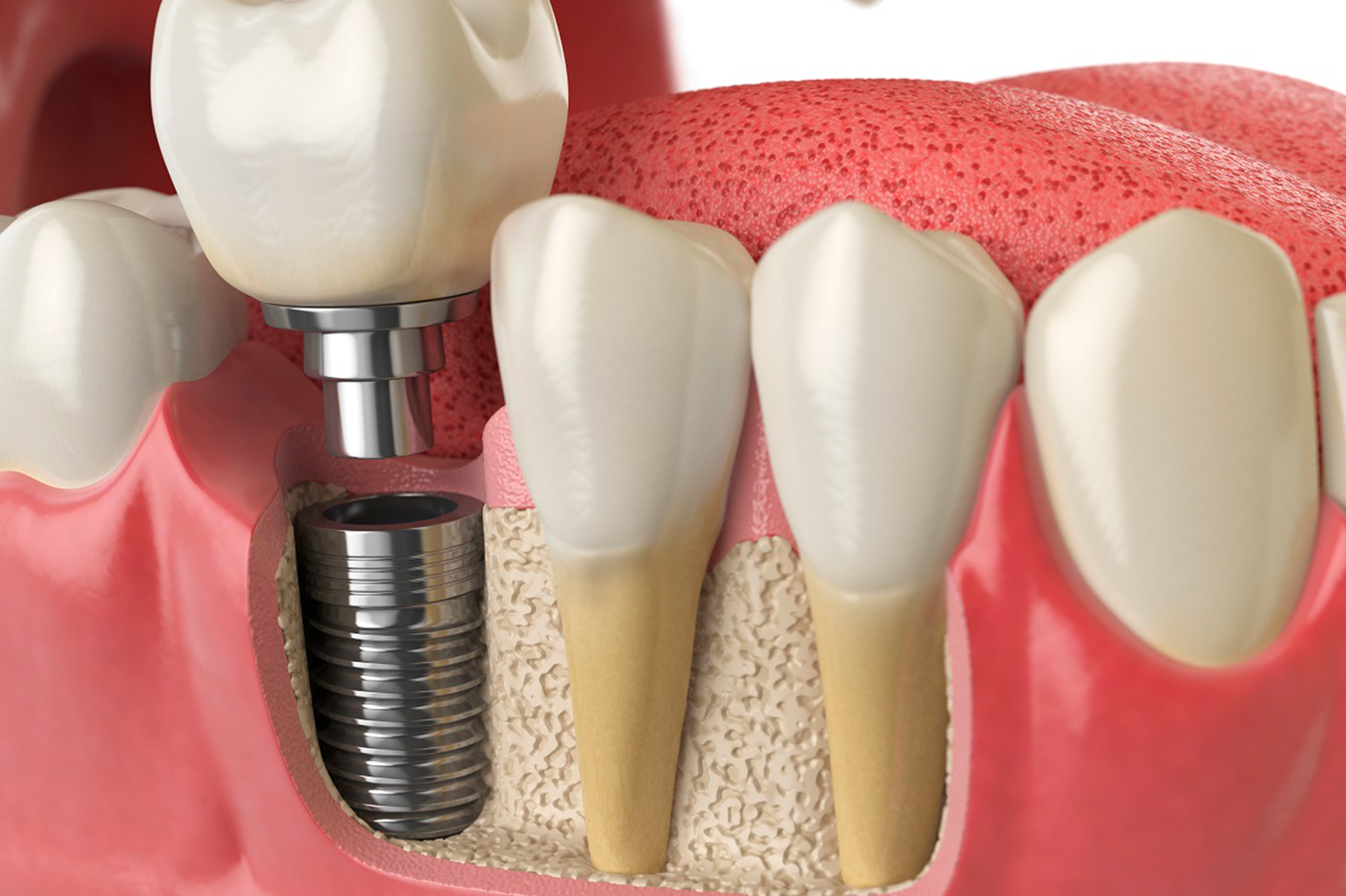 SAIBA MAIS SOBRE IMPLANTES