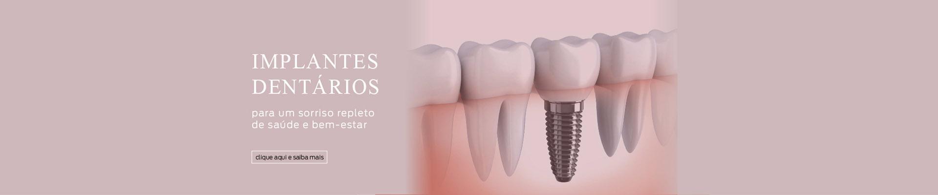 Implantes Dentários